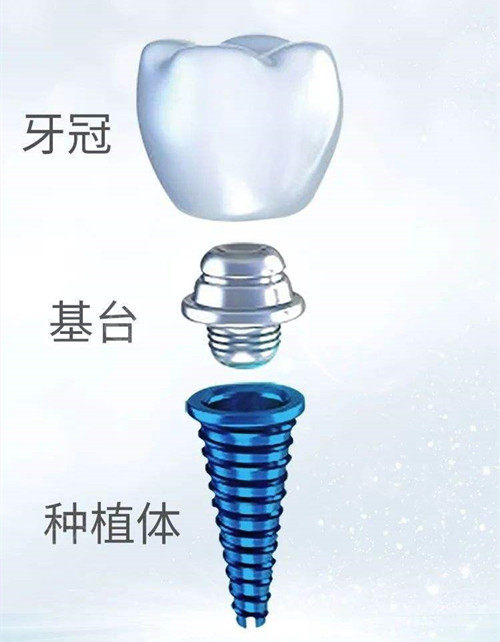 种植牙基台和种植体是配套的吗?通常是~配套基台更能确保种植牙的密合性和稳定性!