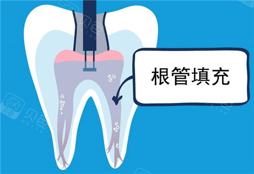 小技巧！根管再治疗牙胶尖如何顺利取出？机械去除|化学溶解|综合应用等方法及注意事项揭晓！ - 沃牙网