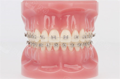 forestadent怎么读品牌大赏！细数进口自锁托槽有哪些品牌：奥美科／非凡／3M／拓美等品牌让你的矫正之路更高端！_https://www.jmylbn.com_新闻资讯_第3张