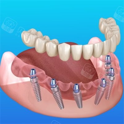 种植牙半口带冠漫画图