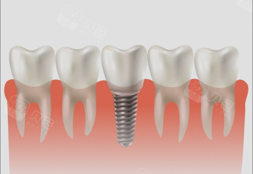 种植牙单颗漫画示意图