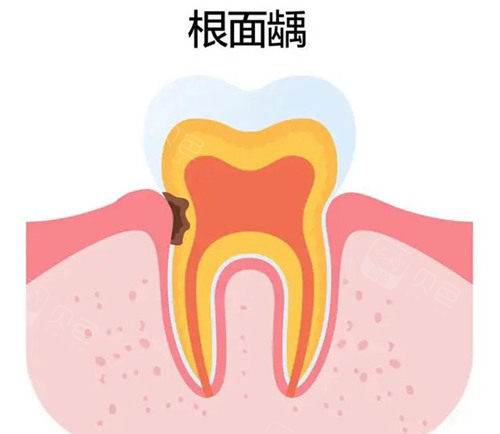 牙齿龋坏六种洞型图片分享~想查看牙齿坏了的图片的可以来了解下龋齿的分类和表现症状! - 沃牙网
