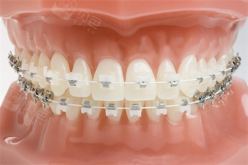 forestadent怎么读【选择指南】自锁托槽哪个牌子好？自锁托槽十大品牌包含：奥美科｜3M｜非凡｜拓美｜奥美等！_https://www.jmylbn.com_新闻资讯_第2张