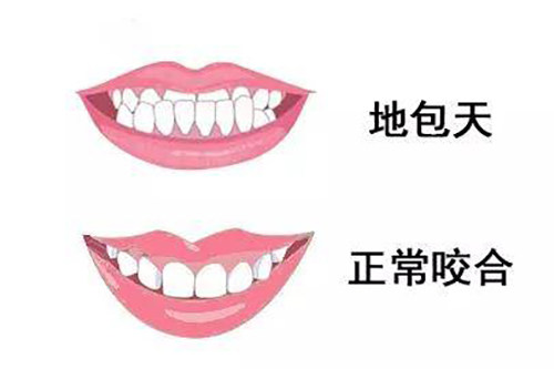 地包天医生说骨性整不了?详细揭晓哪些地包天可以矫正,哪些需要做手术矫正! - 沃牙网