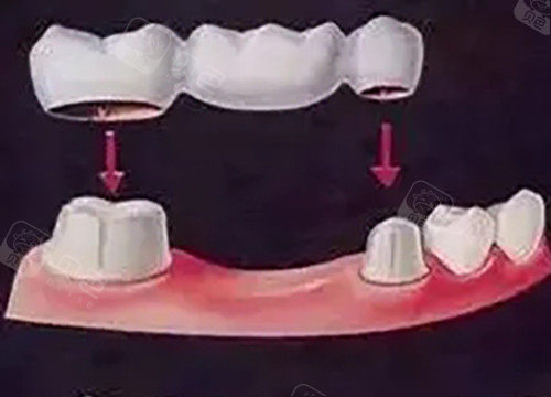 原理解析!固定义齿怎么固定在牙龈上?事实上是固定在两侧邻牙上!来做个详细了解吧! - 沃牙网