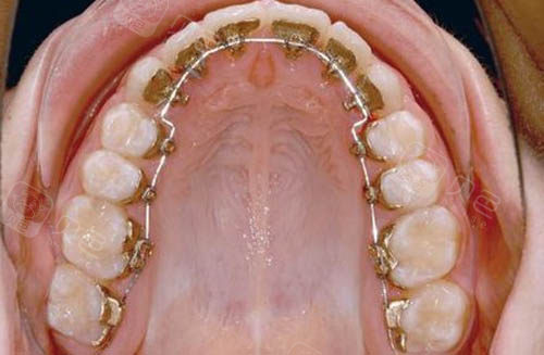 正畸小科普:正畸舌侧扣作用是什么?吞进去怎么办?磨舌头怎么办?