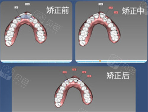 正锁颌用什么矫正牙齿?推荐适合的矫正方案,了解正锁颌矫正牙齿哪种方法好? - 贝色口腔