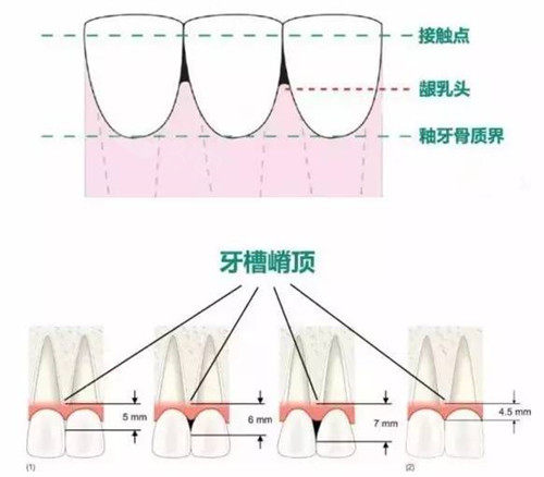 牙齿龈嵴顶在哪里?图解龈嵴顶具体位置!并聊聊龈嵴顶和龈沟的区别是什么? - 沃牙网