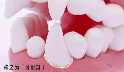 牙龈和牙龈沟是指哪里?详细位置图解来咯!顺便说说龈嵴顶和龈沟的区别是什么 - 沃牙网