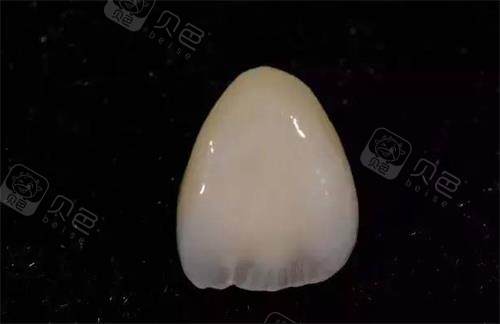 单颗全瓷牙示意图