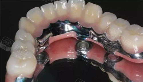 半口种植牙齿照片