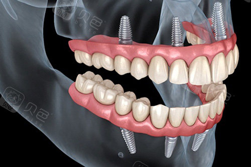 all-on-4种植牙示意图