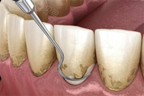 口腔激光怎么治疗激光牙周治疗全口要多少钱？根据严重程度不同,费用在1400元到5800元之间波动!_https://www.jmylbn.com_新闻资讯_第2张