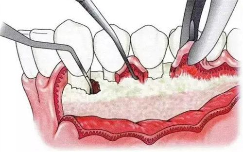 口腔激光怎么治疗激光牙周治疗全口要多少钱？根据严重程度不同,费用在1400元到5800元之间波动!_https://www.jmylbn.com_新闻资讯_第4张