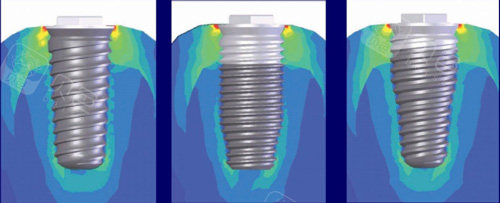 不同尺寸的植体照片