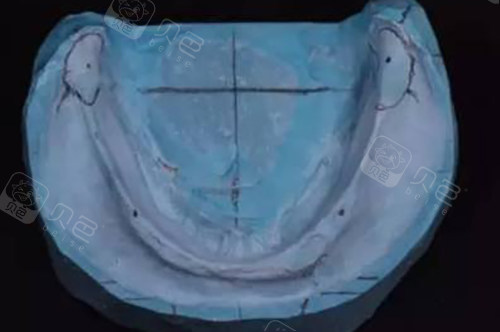 牙科材料硅胶怎么用义齿软衬材料使用方法解析：从术前认识材料｜选择适合材料｜操作步骤｜术后维护全流程揭晓！_https://www.jmylbn.com_新闻资讯_第2张