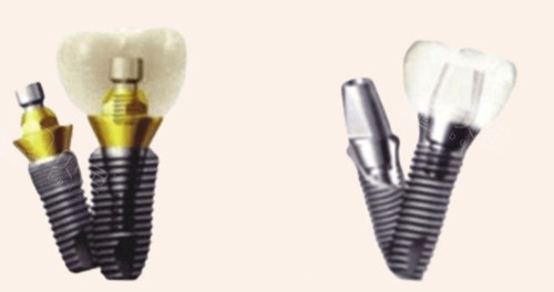 口腔种植手术包怎么打种植牙收费都包含哪些东西？主要包含检查+种植体材料+手术+牙冠修复+调整费用_https://www.jmylbn.com_新闻资讯_第2张