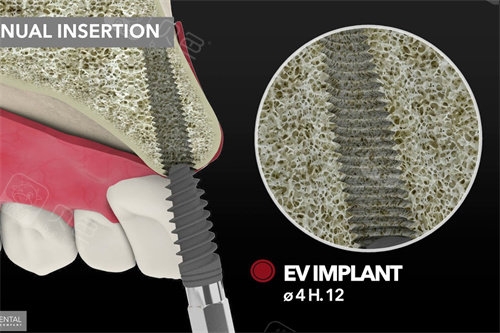 EV是什么针意大利BB种植牙全系列解析，3P、EV、SLIM窄颈、WIDE宽颈、MINI五大系列针对性选择！_https://www.jmylbn.com_新闻资讯_第3张