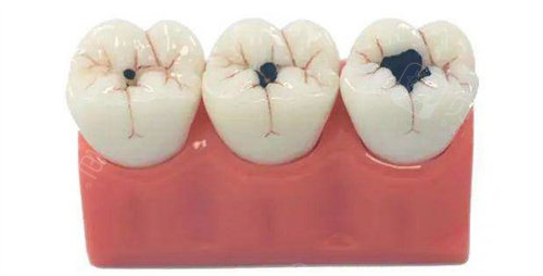 口腔光固化灯是什么光光固化树脂补牙牢固吗？牢固性较高！详细分析光固化树脂补牙的优点~快来了解_https://www.jmylbn.com_新闻资讯_第1张