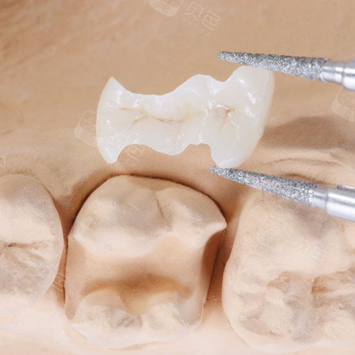 口腔光固化灯是什么光光固化树脂补牙牢固吗？牢固性较高！详细分析光固化树脂补牙的优点~快来了解_https://www.jmylbn.com_新闻资讯_第3张