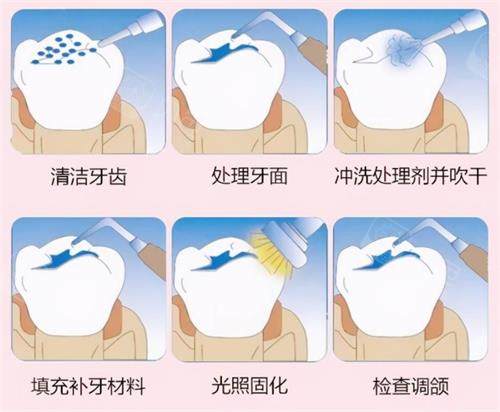 口腔光固化灯是什么光光固化树脂补牙牢固吗？牢固性较高！详细分析光固化树脂补牙的优点~快来了解_https://www.jmylbn.com_新闻资讯_第4张