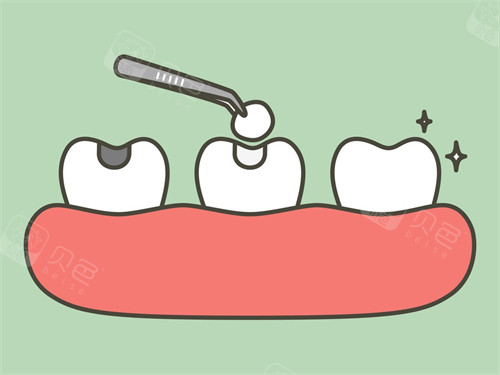 口腔光固化灯是什么光光固化树脂补牙牢固吗？牢固性较高！详细分析光固化树脂补牙的优点~快来了解_https://www.jmylbn.com_新闻资讯_第5张
