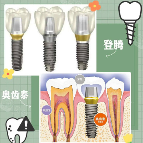 愈合机台怎么识别型号奥齿泰愈合基台型号大揭秘！考虑牙齿位置、牙龈状况等选合适型号，愈合与永久基台差异也明晰_https://www.jmylbn.com_新闻资讯_第1张
