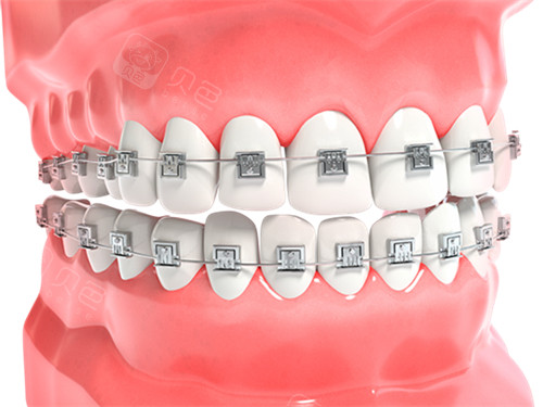 牙齿矫正金属牙套漫画图