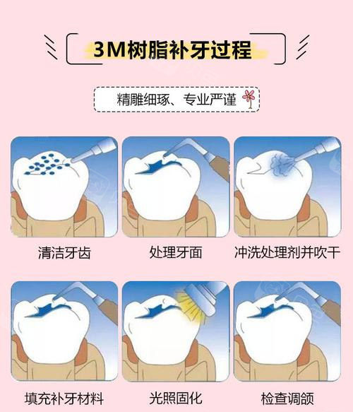 3M树脂补牙方法