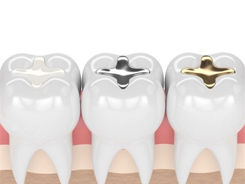 不同补牙材料成效漫画图