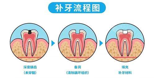 补牙的流程