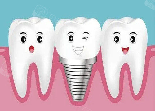 种植牙和真牙卡通示意图