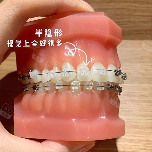 牙齿矫正陶瓷自锁托槽模型