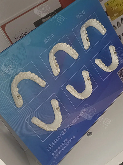 隐秀隐形牙齿矫正