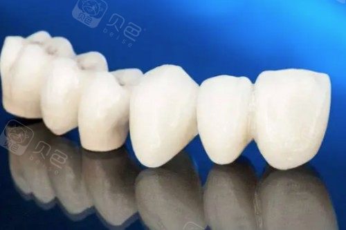 爱尔创全瓷牙模型图