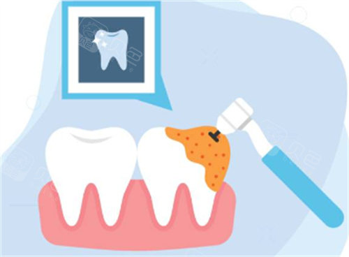 牙钻治疗牙齿图