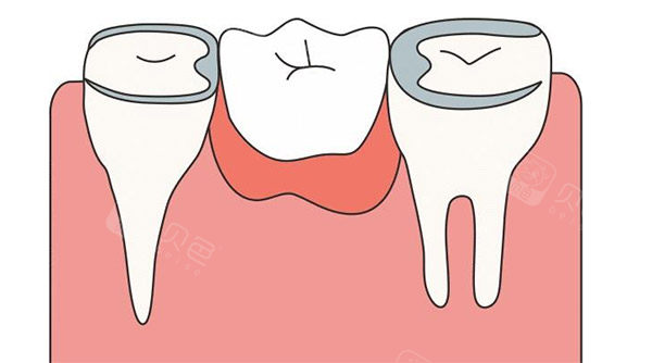 日本再生牙一万一颗正常吗?价格虽高但技术确实惊艳,值不值看完就知道