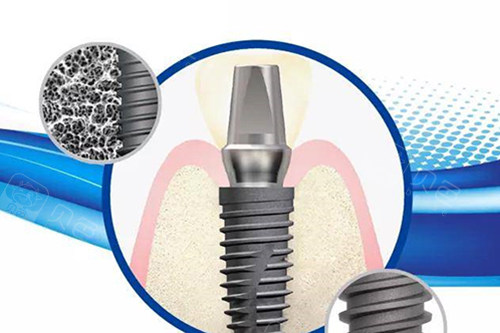 仕诺康种植体和奥齿泰到底有啥区别?看完这篇再也不怕被坑啦!