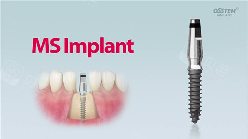 仕诺康种植体和奥齿泰到底有啥区别?看完这篇再也不怕被坑啦!