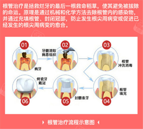 为什么要用根管马达拔牙根管不再“遭罪”？齿科微动力设备揭秘：更准一些操作+低痛感，看牙体验大升级_https://www.jmylbn.com_新闻资讯_第1张