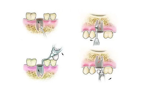 为什么要用根管马达拔牙根管不再“遭罪”？齿科微动力设备揭秘：更准一些操作+低痛感，看牙体验大升级_https://www.jmylbn.com_新闻资讯_第3张