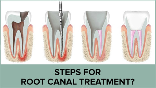 为什么要用根管马达拔牙根管不再“遭罪”？齿科微动力设备揭秘：更准一些操作+低痛感，看牙体验大升级_https://www.jmylbn.com_新闻资讯_第4张