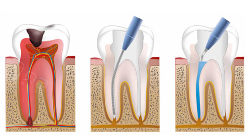 为什么要用根管马达拔牙根管不再“遭罪”？齿科微动力设备揭秘：更准一些操作+低痛感，看牙体验大升级_https://www.jmylbn.com_新闻资讯_第5张