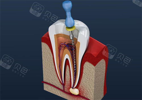为什么要用根管马达拔牙根管不再“遭罪”？齿科微动力设备揭秘：更准一些操作+低痛感，看牙体验大升级_https://www.jmylbn.com_新闻资讯_第6张