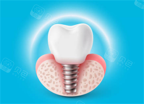 咸陽武功縣牙科醫院哪家好?功縣艾斯美康口腔和卓越牙康口腔看牙齒種牙正畸口碑好！