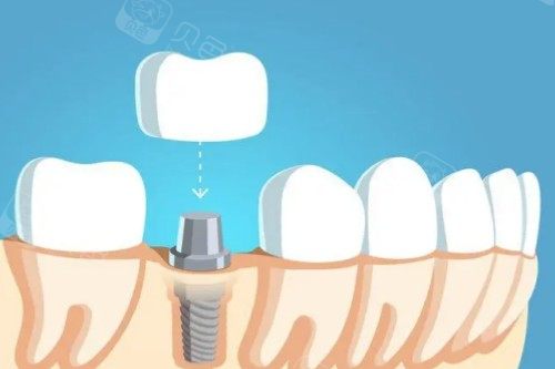 做牙冠打樁好還是不打樁好？牙體缺損大于1/2建議纖維樁加固！