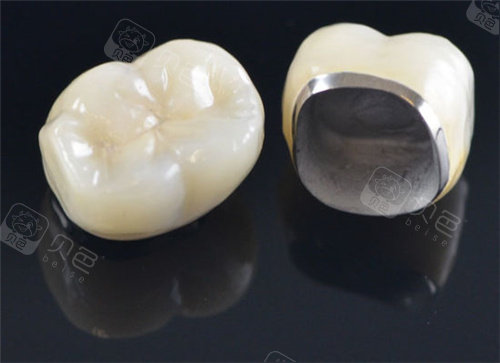 做牙冠打樁好還是不打樁好？牙體缺損大于1/2建議纖維樁加固！