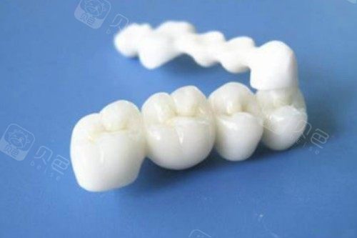 大牙做全瓷牙需要把牙磨成什么樣子？牙體磨除量控制在0.8-1.5mm，保留健康牙本質！