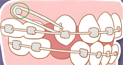 正規口腔醫院牙齒矯正2025-2026價格一覽，常見金屬托槽/隱形矯正/舌側矯正/兒童矯正費用都有