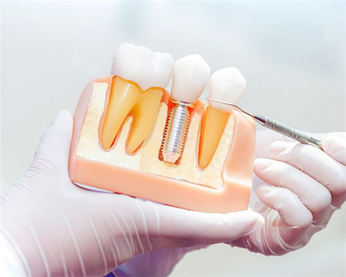 韓國種植牙質量排行榜已更新，內含韓國種植牙品牌及價格參考